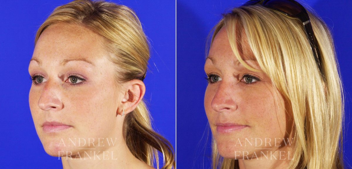 Rhinoplasty before and after photos in Beverly Hills, CA, Patient 5471