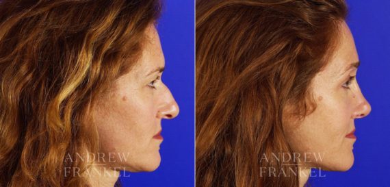 Rhinoplasty before and after photos in Beverly Hills, CA, Patient 5506