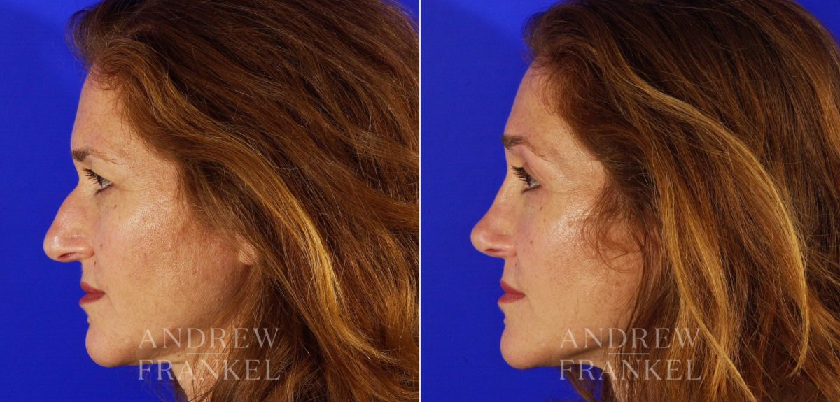 Rhinoplasty before and after photos in Beverly Hills, CA, Patient 5506