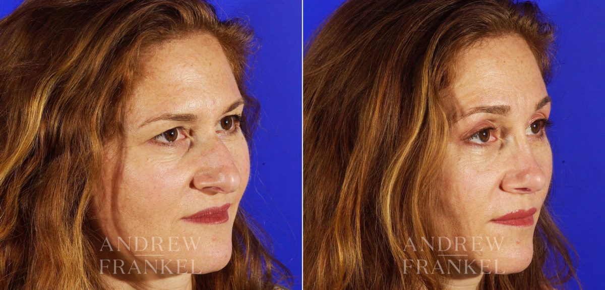 Rhinoplasty before and after photos in Beverly Hills, CA, Patient 5506