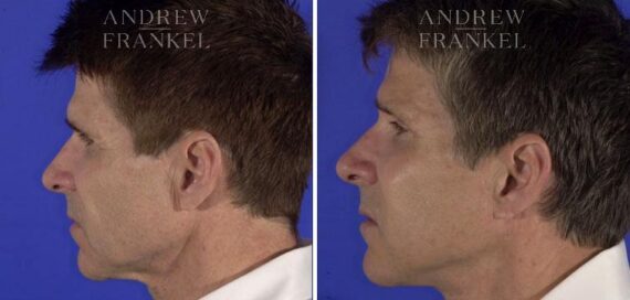 Facelift before and after photos in Beverly Hills, CA, Patient 5516