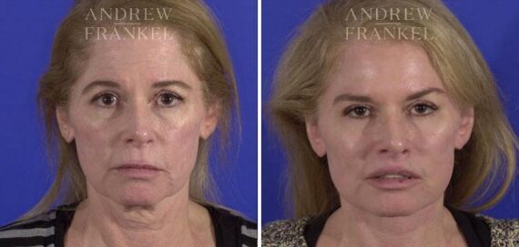 Facelift before and after photos in Beverly Hills, CA, Patient 5530