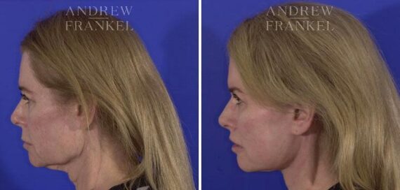 Facelift before and after photos in Beverly Hills, CA, Patient 5530