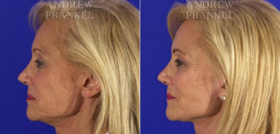 Facelift before and after photos in Beverly Hills, CA, Patient 5552