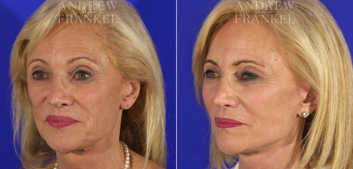 Facelift before and after photos in Beverly Hills, CA, Patient 5552