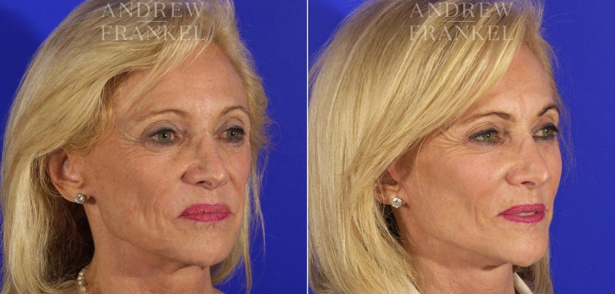 Facelift before and after photos in Beverly Hills, CA, Patient 5552
