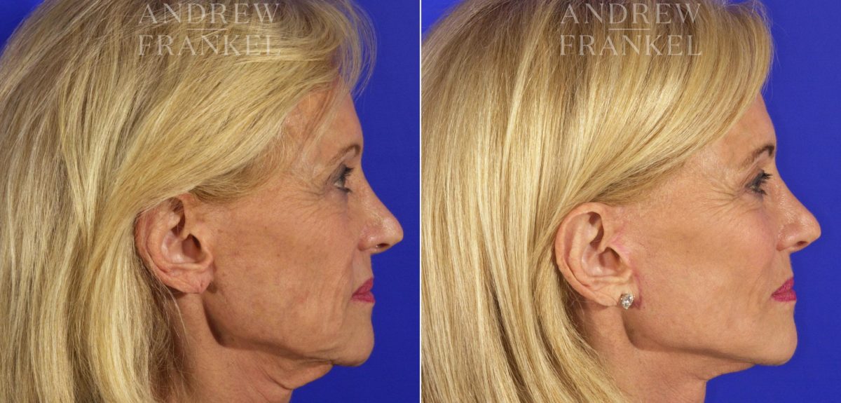 Facelift before and after photos in Beverly Hills, CA, Patient 5552