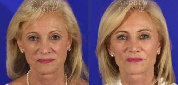 Facelift before and after photos in Beverly Hills, CA, Patient 5552