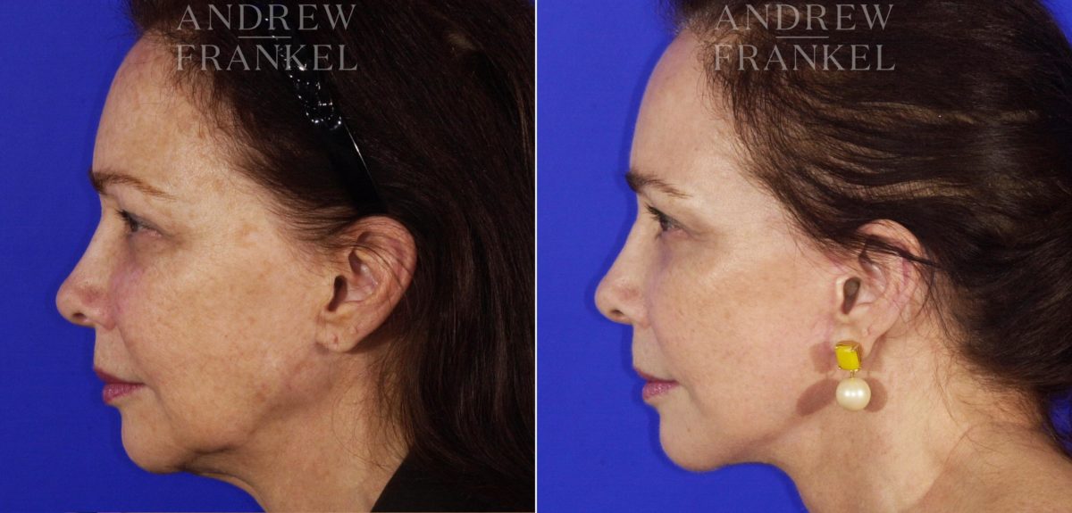 Facelift before and after photos in Beverly Hills, CA, Patient 5579