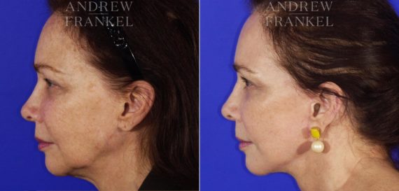 Facelift before and after photos in Beverly Hills, CA, Patient 5579
