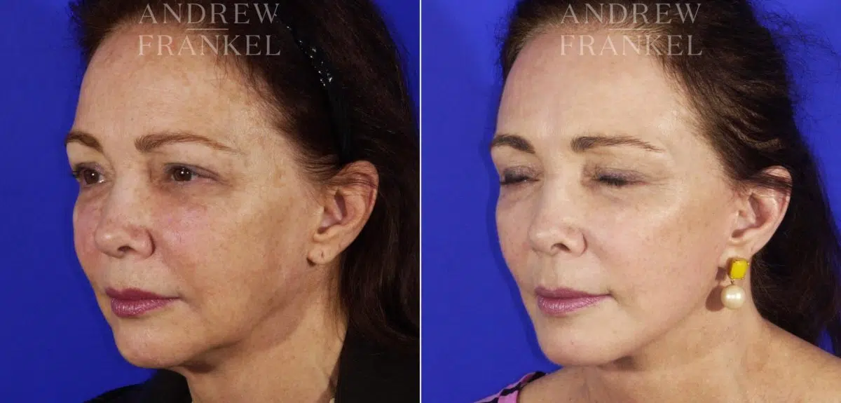 Facelift before and after photos in Beverly Hills, CA, Patient 5579