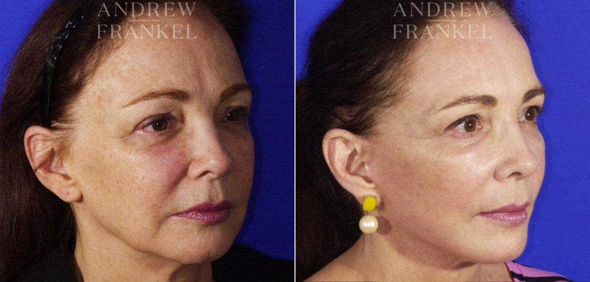 Facelift before and after photos in Beverly Hills, CA, Patient 5579