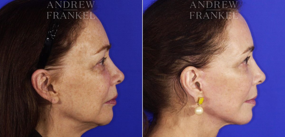 Facelift before and after photos in Beverly Hills, CA, Patient 5579