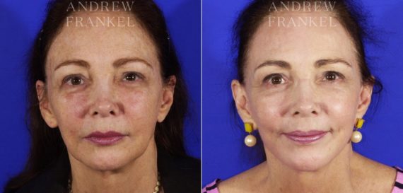 Facelift before and after photos in Beverly Hills, CA, Patient 5579