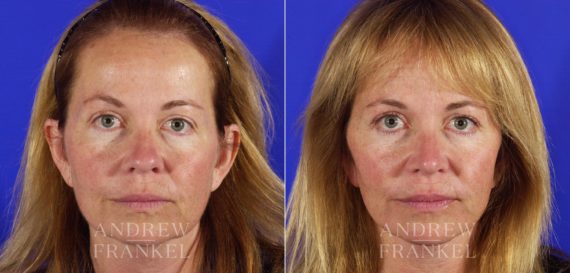 Rhinoplasty before and after photos in Beverly Hills, CA, Patient 5582