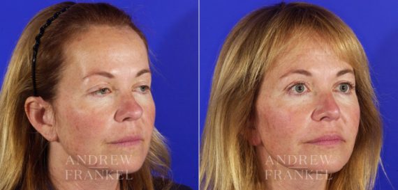 Rhinoplasty before and after photos in Beverly Hills, CA, Patient 5582