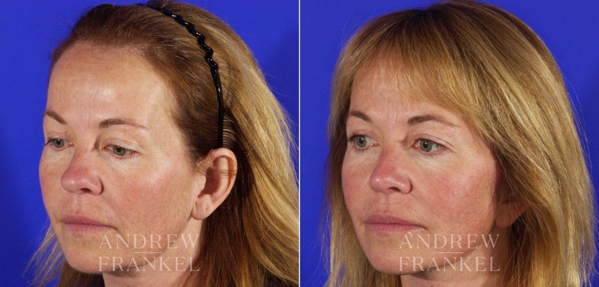 Rhinoplasty before and after photos in Beverly Hills, CA, Patient 5582