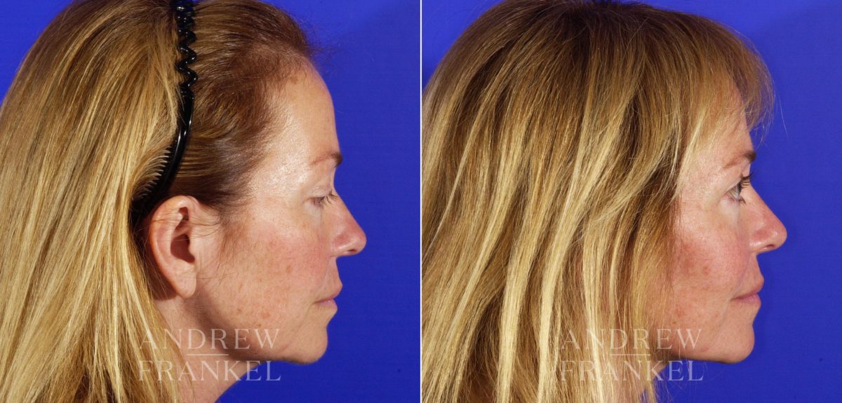Rhinoplasty before and after photos in Beverly Hills, CA, Patient 5582