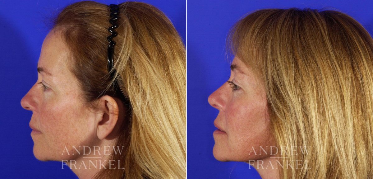 Rhinoplasty before and after photos in Beverly Hills, CA, Patient 5582