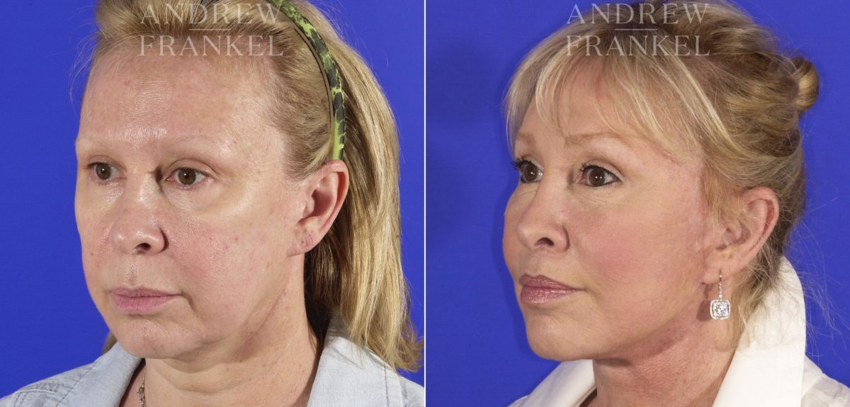 Facelift before and after photos in Beverly Hills, CA, Patient 5593