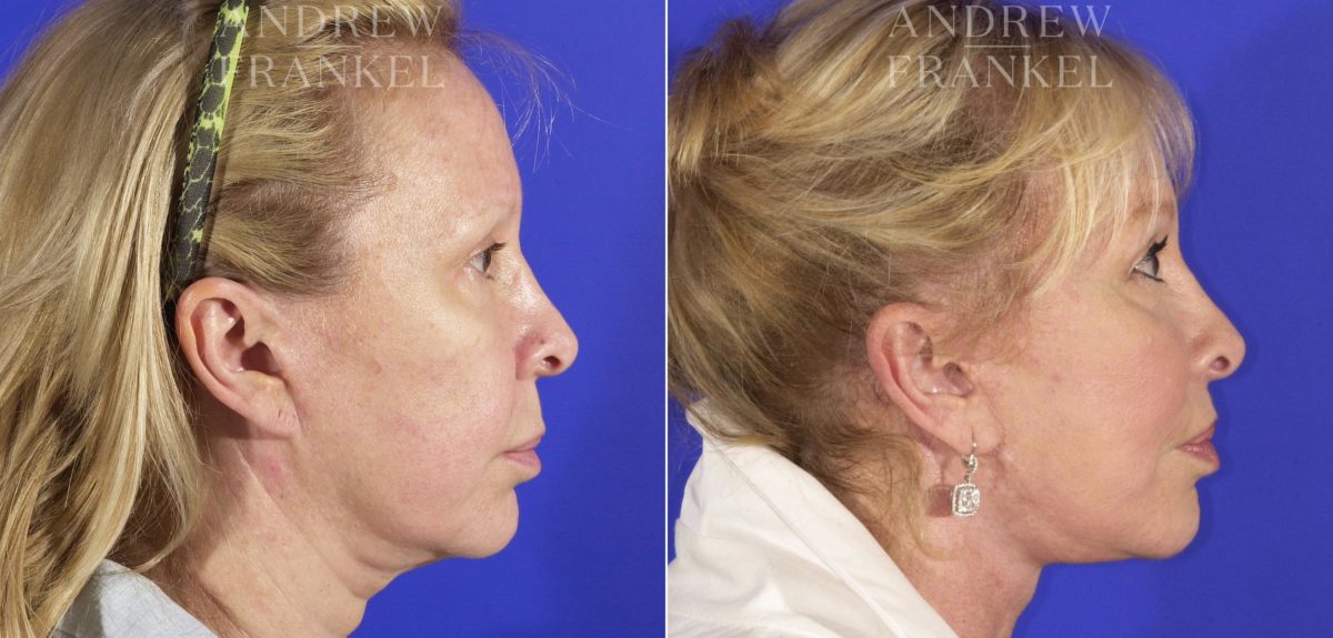 Facelift before and after photos in Beverly Hills, CA, Patient 5593