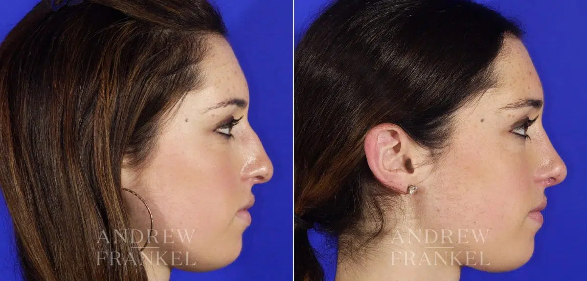 Rhinoplasty before and after photos in Beverly Hills, CA, Patient 5616