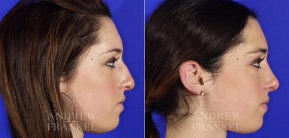 Rhinoplasty before and after photos in Beverly Hills, CA, Patient 5616