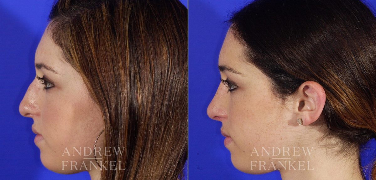 Rhinoplasty before and after photos in Beverly Hills, CA, Patient 5616