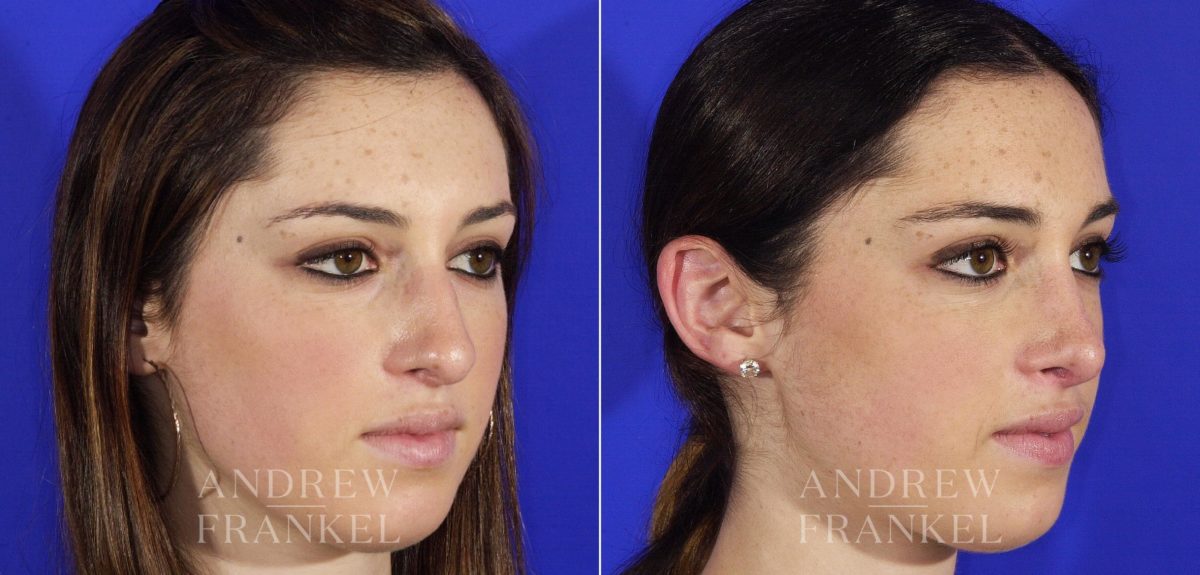Rhinoplasty before and after photos in Beverly Hills, CA, Patient 5616