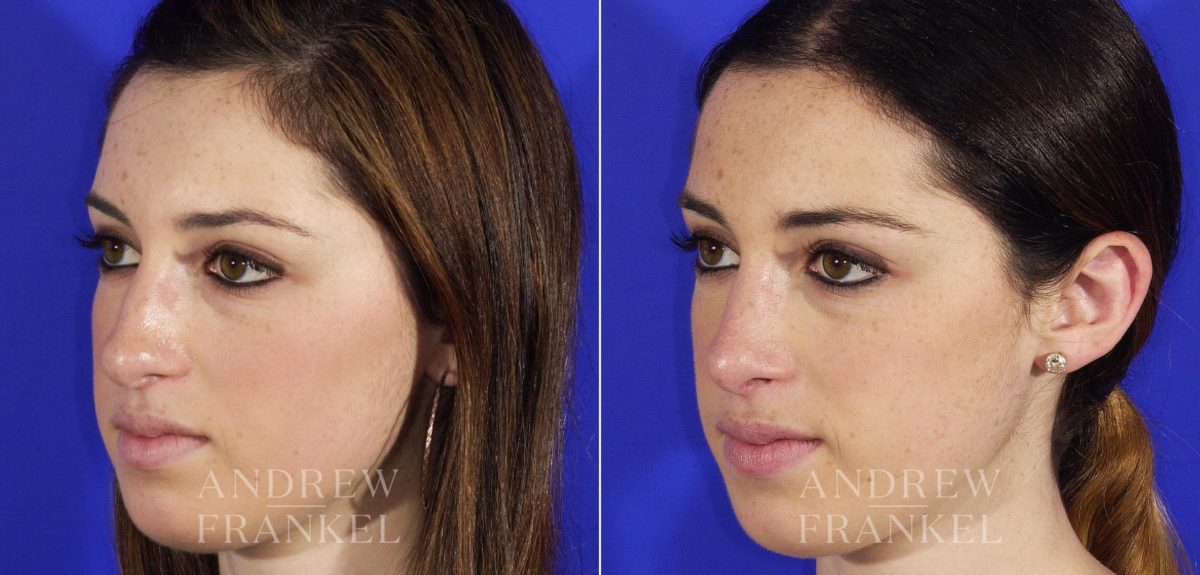 Rhinoplasty before and after photos in Beverly Hills, CA, Patient 5616