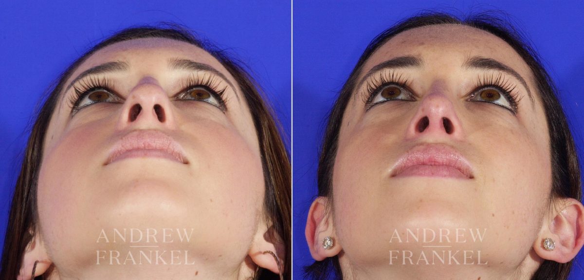 Rhinoplasty before and after photos in Beverly Hills, CA, Patient 5616