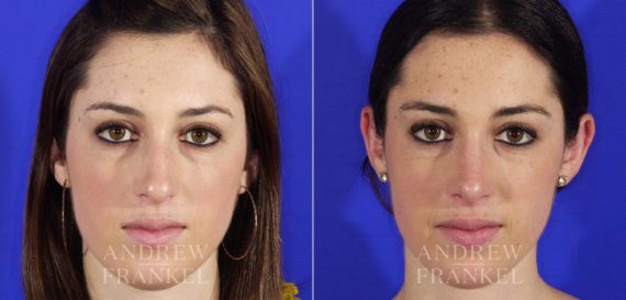 Rhinoplasty before and after photos in Beverly Hills, CA, Patient 5616