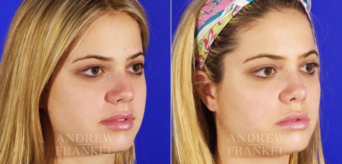 Rhinoplasty before and after photos in Beverly Hills, CA, Patient 5653
