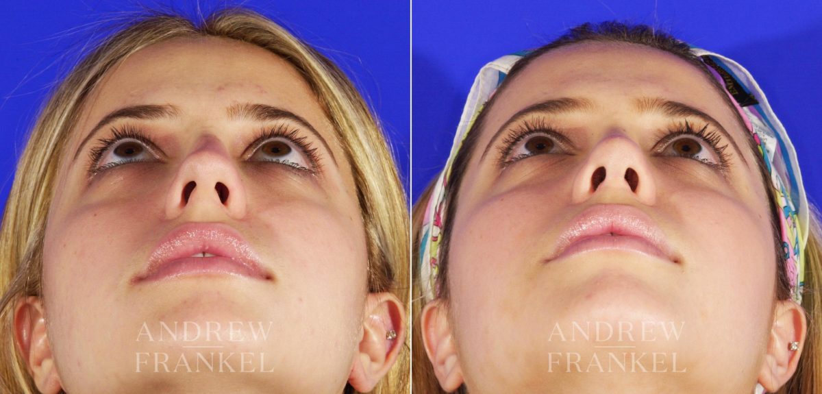 Rhinoplasty before and after photos in Beverly Hills, CA, Patient 5653