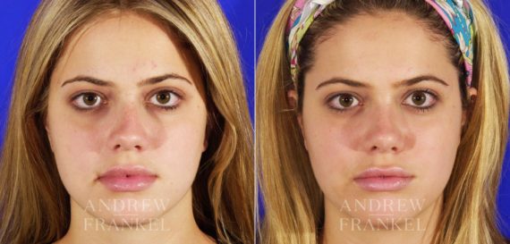 Rhinoplasty before and after photos in Beverly Hills, CA, Patient 5653