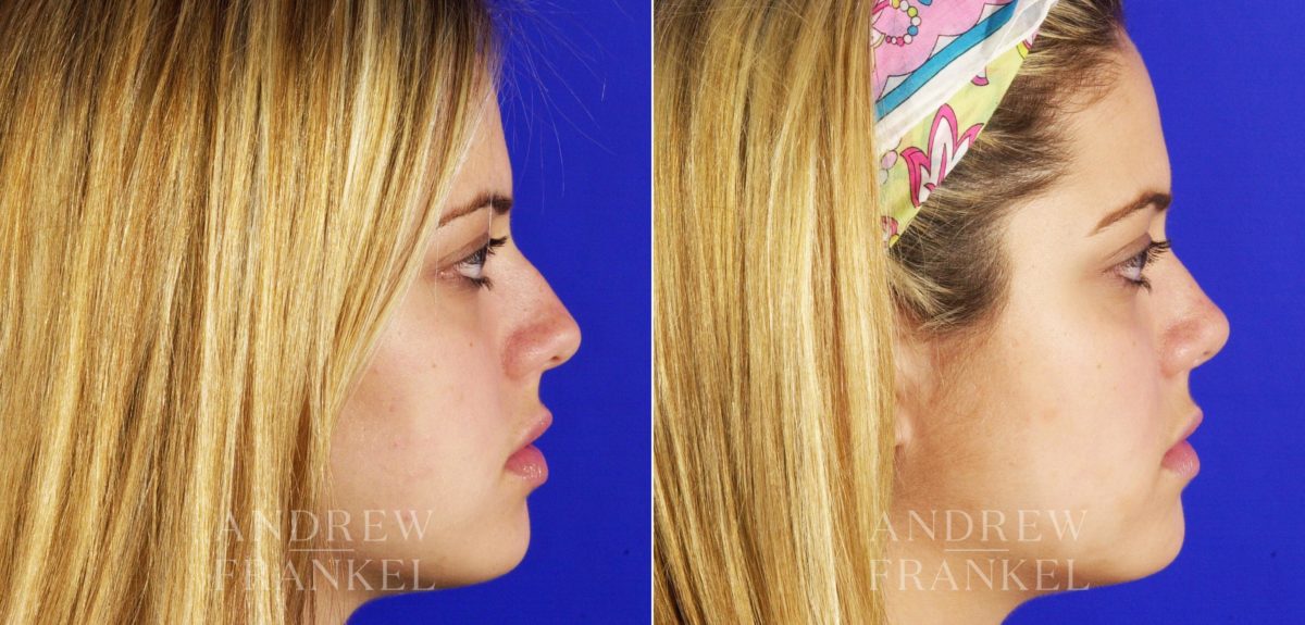Rhinoplasty before and after photos in Beverly Hills, CA, Patient 5653