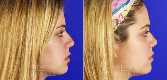 Rhinoplasty before and after photos in Beverly Hills, CA, Patient 5653