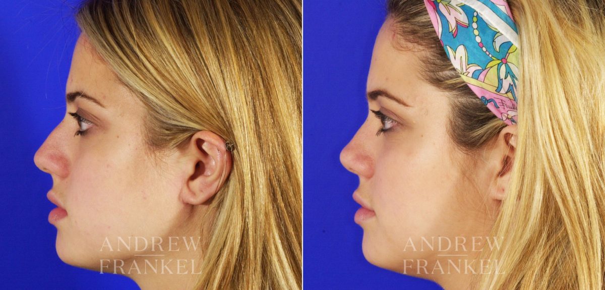 Rhinoplasty before and after photos in Beverly Hills, CA, Patient 5653