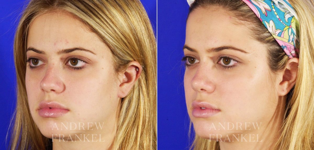 Rhinoplasty before and after photos in Beverly Hills, CA, Patient 5653