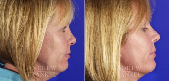 Rhinoplasty before and after photos in Beverly Hills, CA, Patient 5679