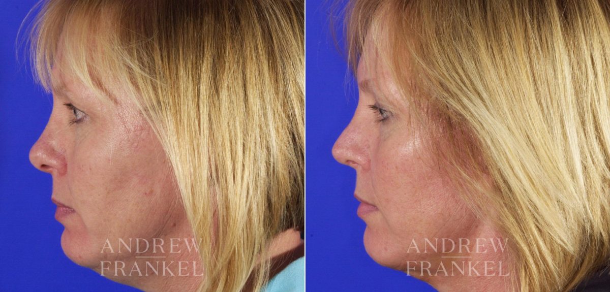 Rhinoplasty before and after photos in Beverly Hills, CA, Patient 5679