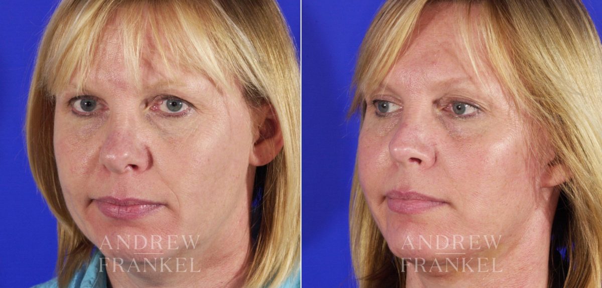 Rhinoplasty before and after photos in Beverly Hills, CA, Patient 5679