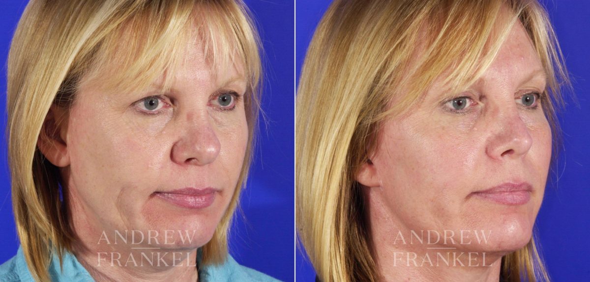 Rhinoplasty before and after photos in Beverly Hills, CA, Patient 5679