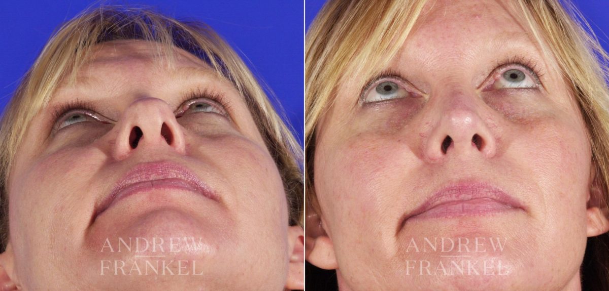 Rhinoplasty before and after photos in Beverly Hills, CA, Patient 5679