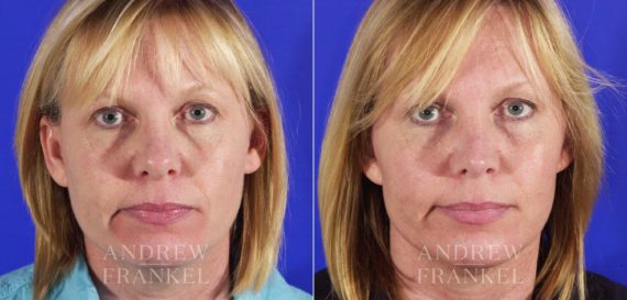 Rhinoplasty before and after photos in Beverly Hills, CA, Patient 5679