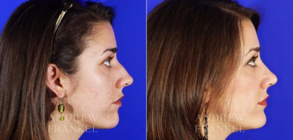 Rhinoplasty before and after photos in Beverly Hills, CA, Patient 5706