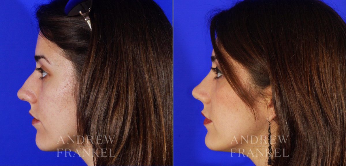 Rhinoplasty before and after photos in Beverly Hills, CA, Patient 5706