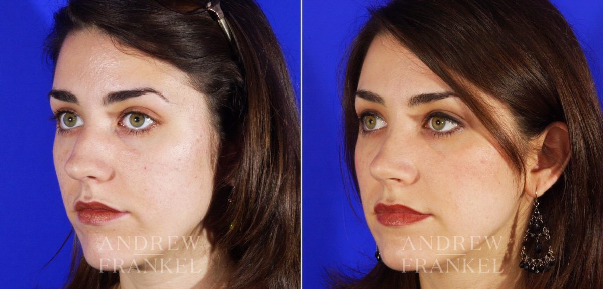 Rhinoplasty before and after photos in Beverly Hills, CA, Patient 5706
