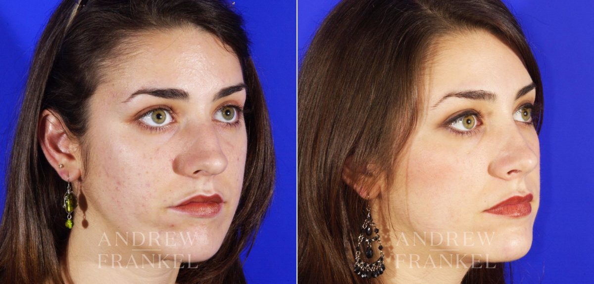 Rhinoplasty before and after photos in Beverly Hills, CA, Patient 5706