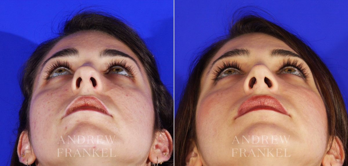 Rhinoplasty before and after photos in Beverly Hills, CA, Patient 5706